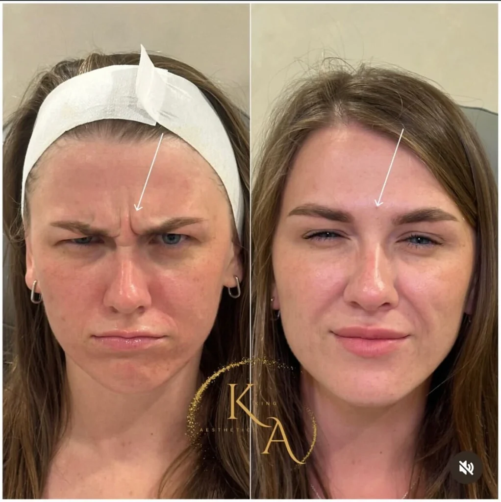 Botox 1