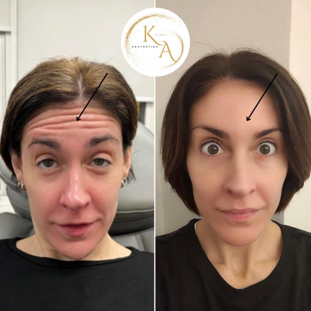 Botox 1