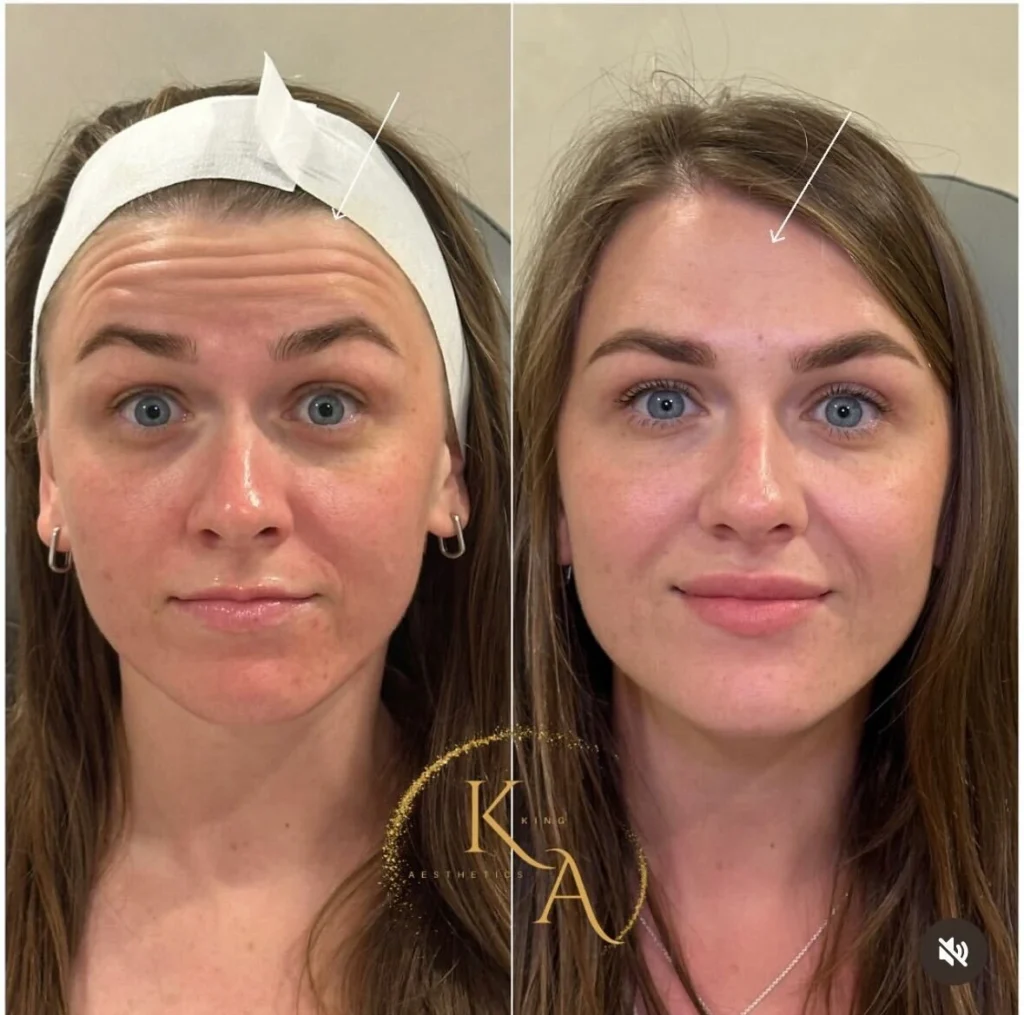 Botox 2