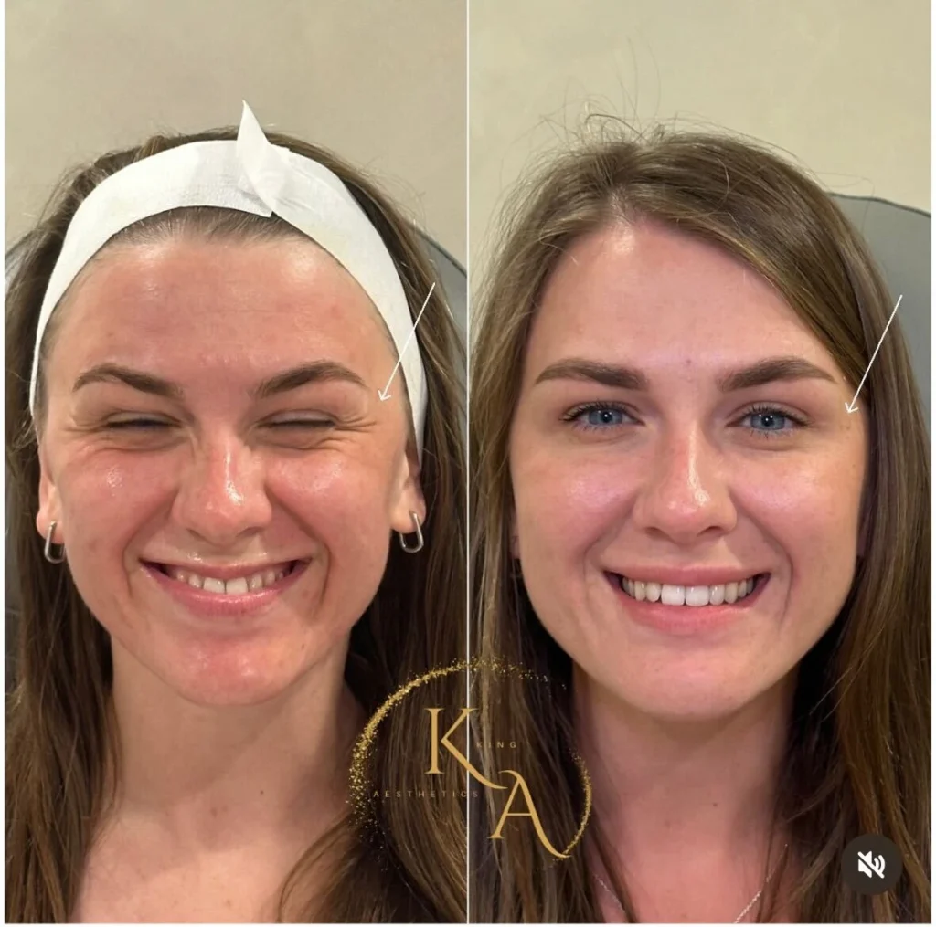 Botox 3
