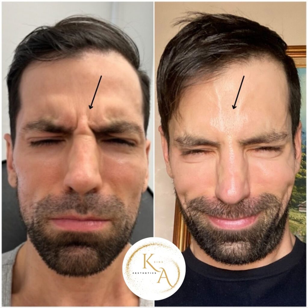 Botox bA2
