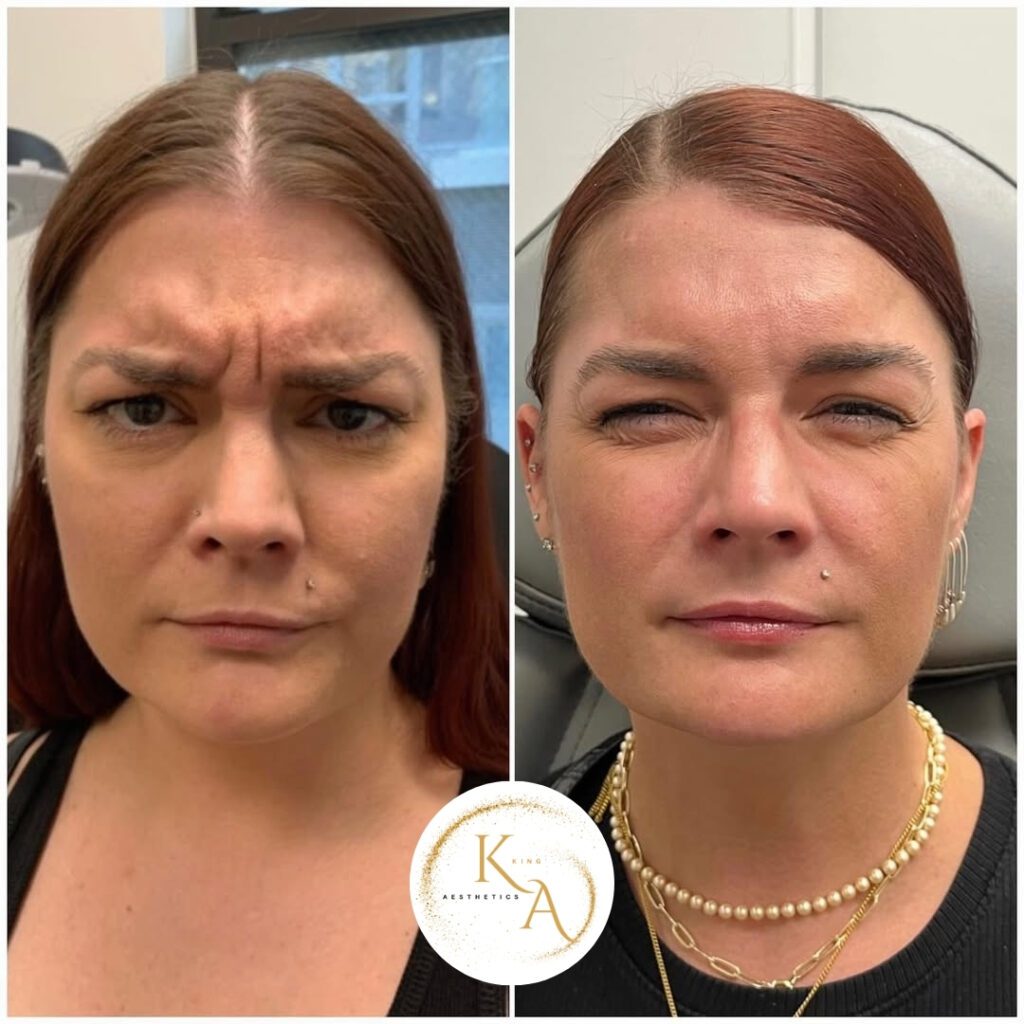 Botox ba