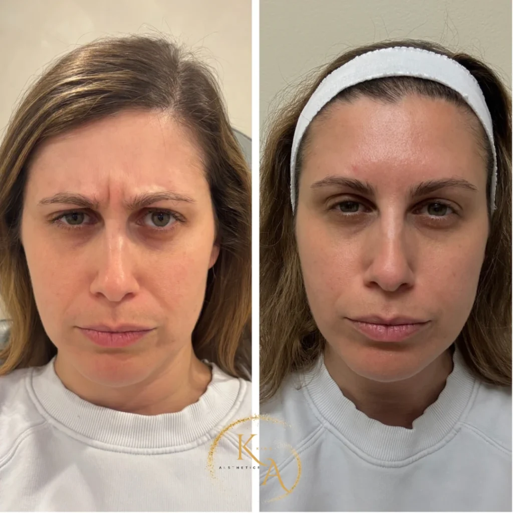 Botox frown