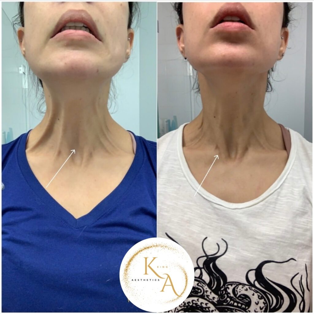 Full face botox bA2