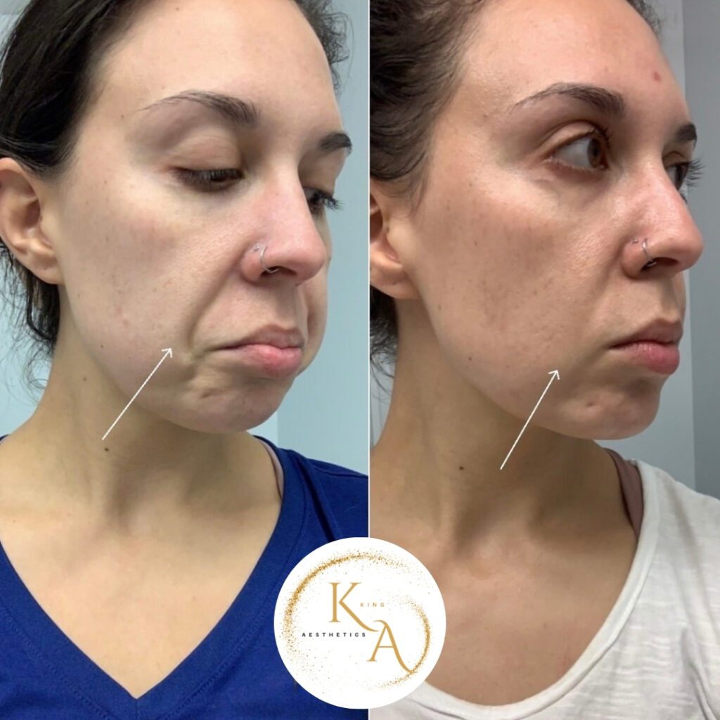 Full face botoxBA