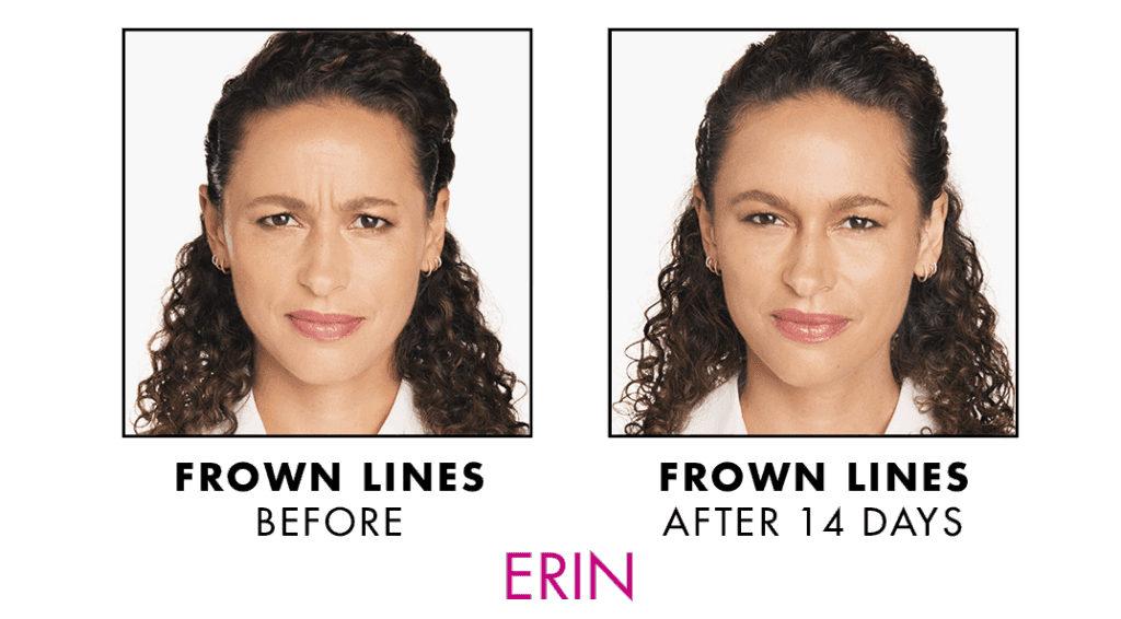 xeomin before and after nyc