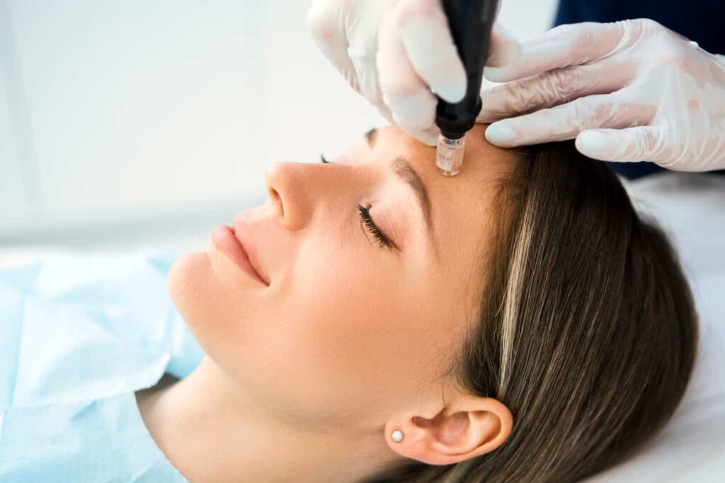 RF Microneedling